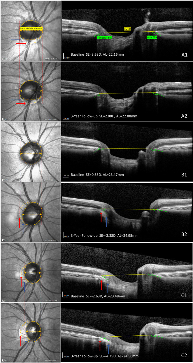 Association of Optic Nerve Head Metrics and Parapapillary Gamma Zone With Myopia Onset and Progression in Children: The Hong Kong Children Eye Study.