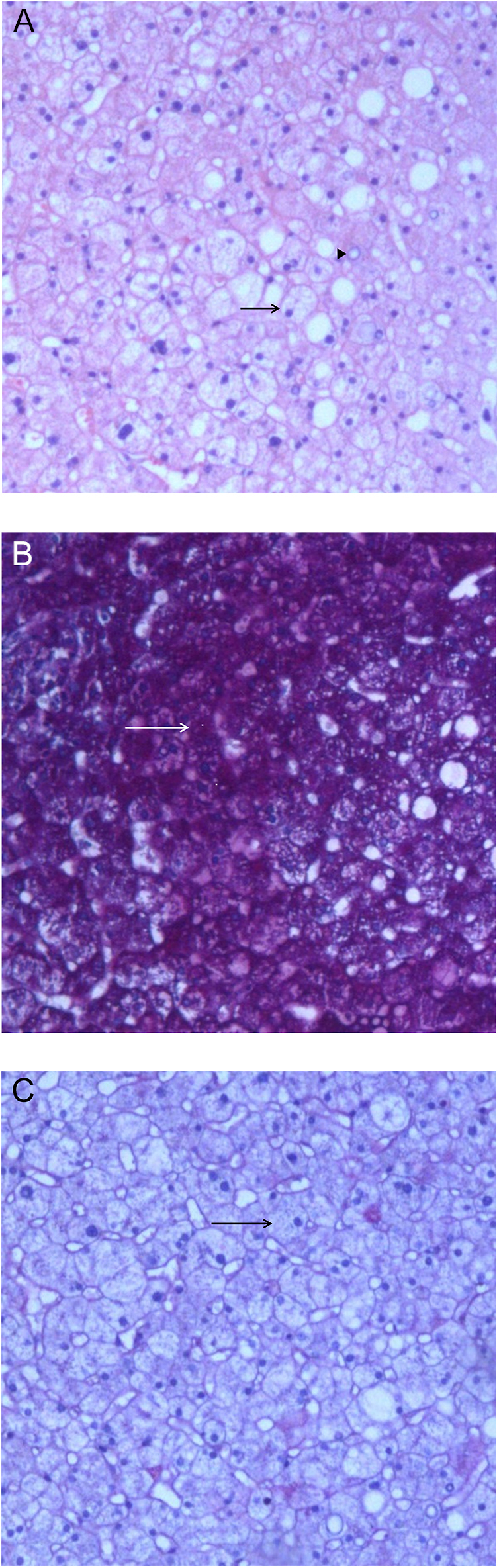 Mauriac syndrome: a rare complication in patients with type 1 diabetes mellitus.