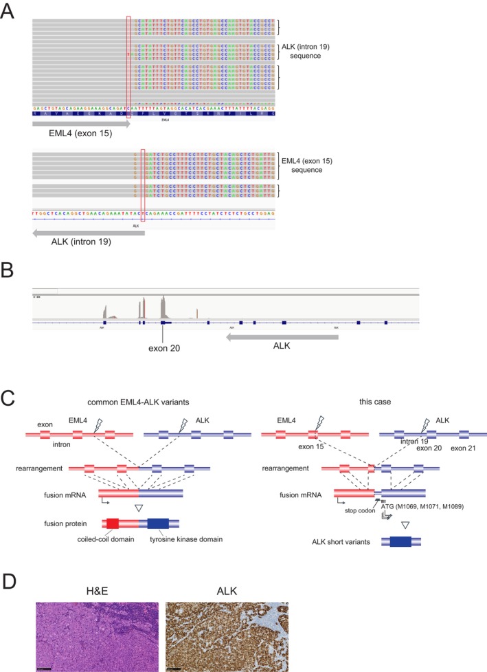 Lung Adenocarcinoma Expressing an EML4-ALK Fusion Transcript With Premature Stop Codons and Response to Alectinib: A Case Report.