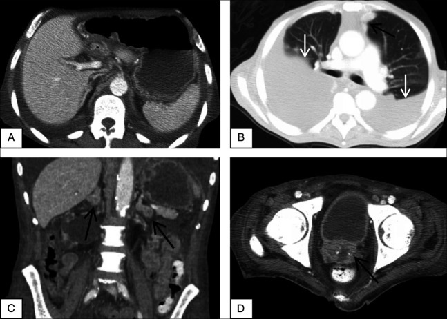 An Unexpected Culprit: Fatal Gastrointestinal Hemorrhage due to Duodenal Histoplasmosis in a Patient With End-Stage Renal Disease.