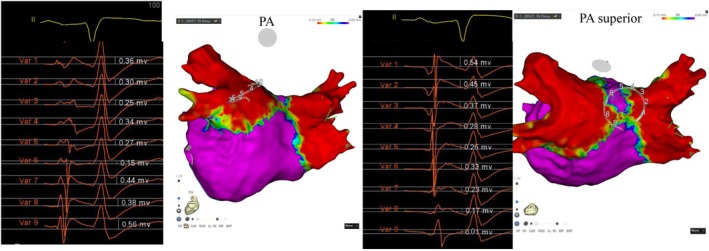Unipolar Signal Augmentation as a Novel Marker of Tissue Contact in Pulsed Field Ablation.