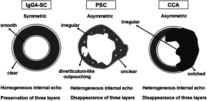 Endoscopic diagnosis of immunoglobulin G4-related sclerosing cholangitis.