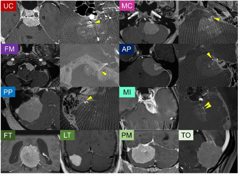 Integrated molecular and detailed anatomical profiling identifies a prognostically adverse subtype of posterior fossa meningiomas: high-risk copy number alterations are associated with midline predilection and predict poor prognosis.