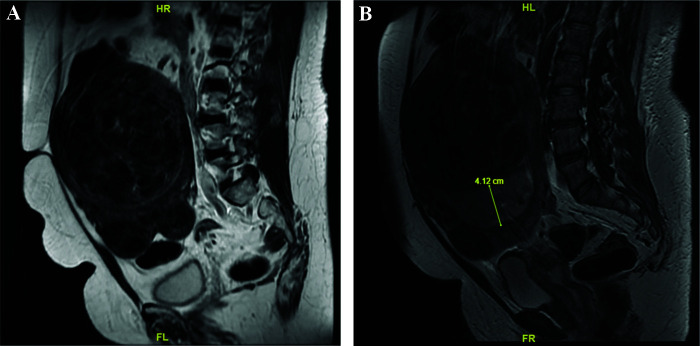 A Rare Case of Uterine Embryonal Rhabdomyosarcoma.