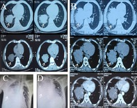 Rapid Progression of Primary Pulmonary NUT Midline Carcinoma: A Case Report and Literature Review.