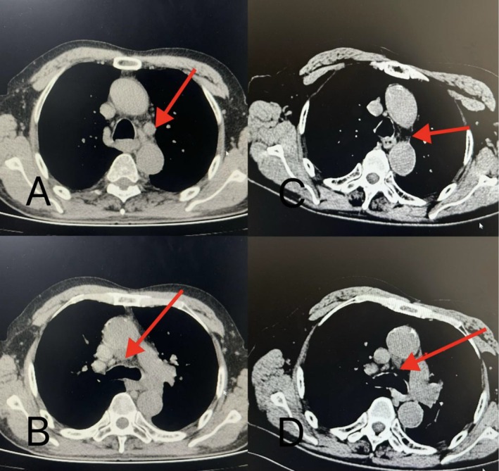 A Case of Advanced Lung Adenocarcinoma Successfully Treated by Intratumoral Injection of Tirelizumab Under Tracheoscopy.