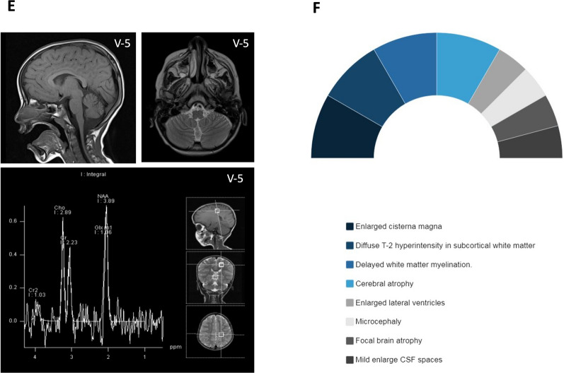 Natural history of SPTBN4-related neurodevelopmental disorder with hypotonia, neuropathy, and deafness.