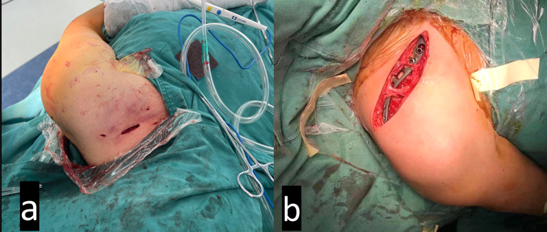 Minimally invasive plate osteosynthesis (MIPO) with mini-open technique versus open reduction and internal fixation (ORIF) in the treatment of displaced midclavicular fracture: a retrospective study.