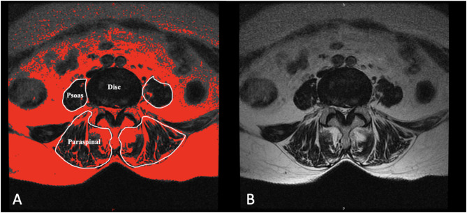 Efficacy analysis of high-intensity laser therapy for post lumbar surgery syndrome.