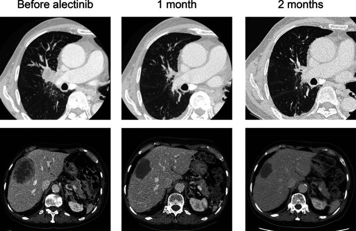 Lung Adenocarcinoma Expressing an EML4-ALK Fusion Transcript With Premature Stop Codons and Response to Alectinib: A Case Report.