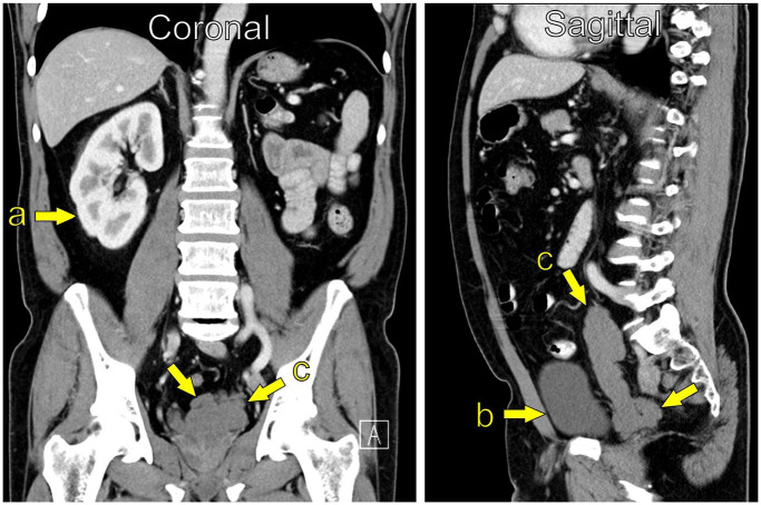 Zinner syndrome: Clinical insights from Western Norway.