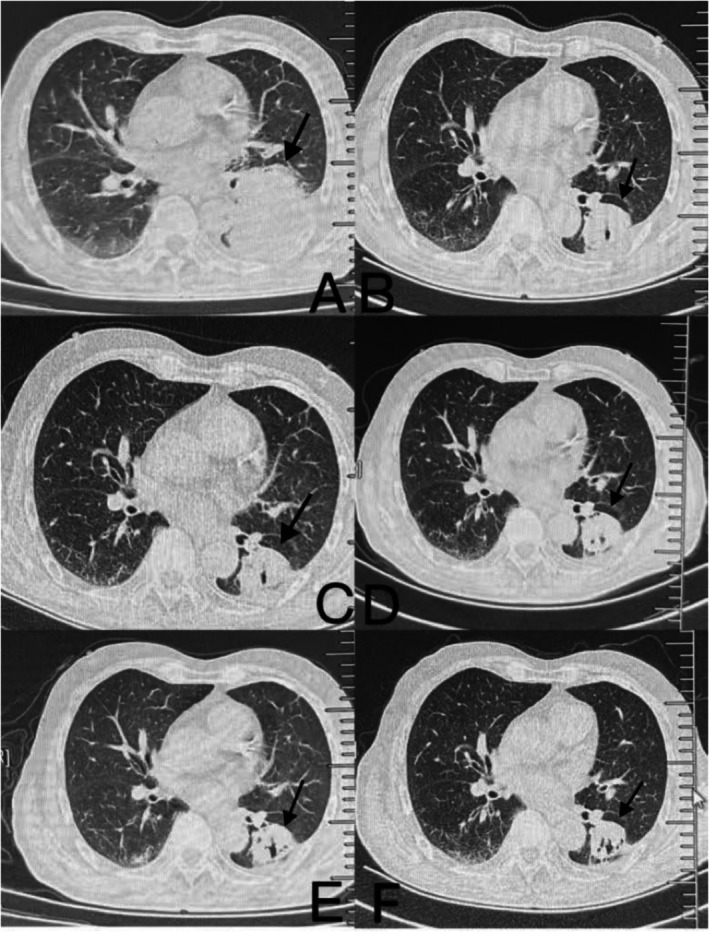 A Case of Advanced Lung Adenocarcinoma Successfully Treated by Intratumoral Injection of Tirelizumab Under Tracheoscopy.