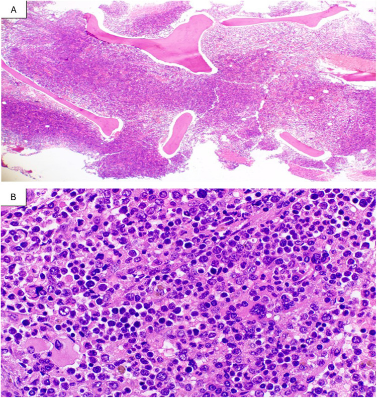 Myelomastocytic transformation in chronic myeloid leukemia blast phase: A case report.