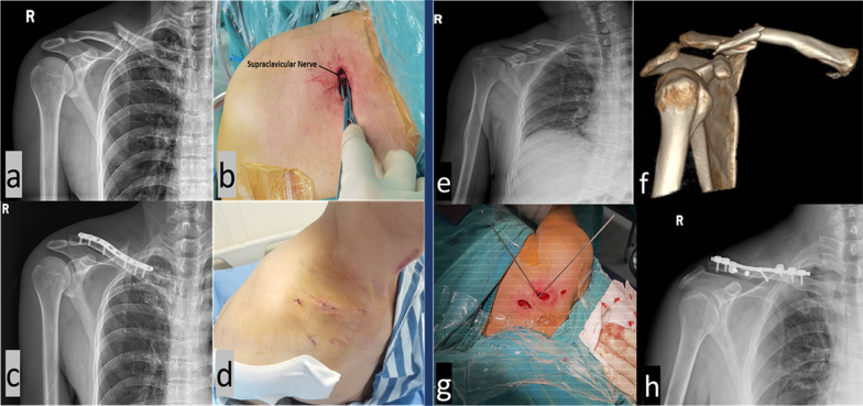 Minimally invasive plate osteosynthesis (MIPO) with mini-open technique versus open reduction and internal fixation (ORIF) in the treatment of displaced midclavicular fracture: a retrospective study.