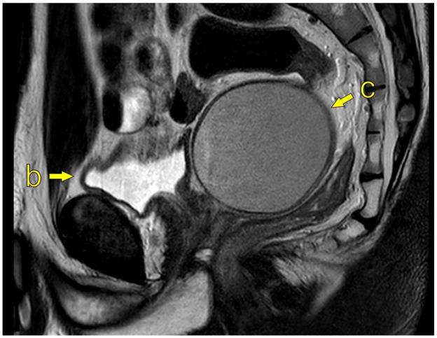 Zinner syndrome: Clinical insights from Western Norway.