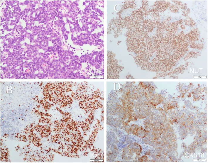 Rapid Progression of Primary Pulmonary NUT Midline Carcinoma: A Case Report and Literature Review.