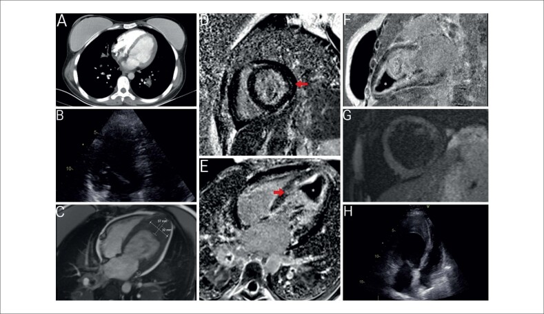 Surprising Cardiac Magnetic Resonance Imaging Findings: Rapidly Developing Intracardiac Thrombus with Endomyocardial Fibrosis.
