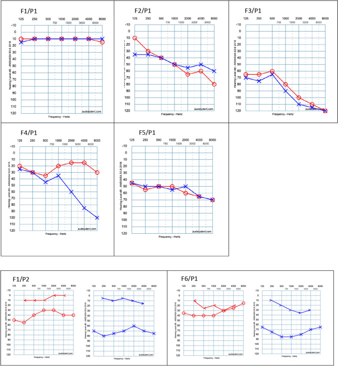 Characteristics of Hearing Loss in Patients with <i>COL2A1</i> Gene Variants (Sticker Syndrome Type 1).
