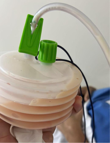 Thoracic Duct Injury in a Patient Undergoing Axillary Lymphadenectomy: A Case Report.