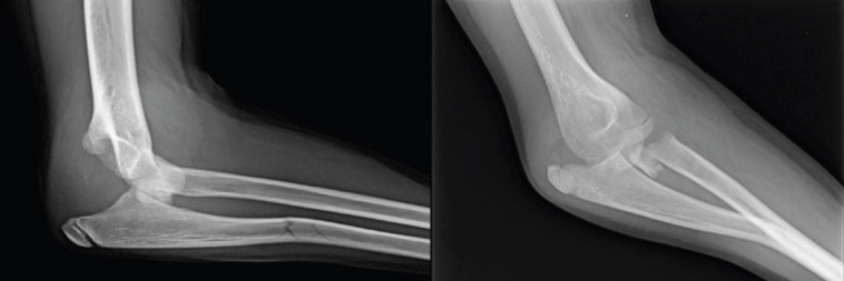 Elbow Dislocation Associated with Severely Displaced Radial Neck Fracture and Ulnar Diaphyseal Fracture in an 11-Year-Old Girl - A Very Rare Case Report.