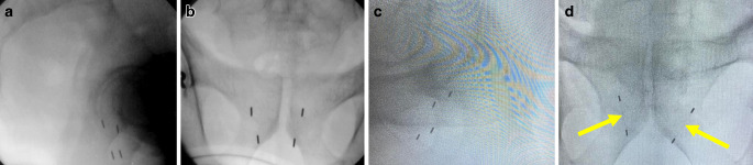 Implant geometry and detection rates of prostate fiducial markers after transrectal ultrasound-guided perineal implantation for image-guided 6D-tracking in robotic stereotactic body radiotherapy.
