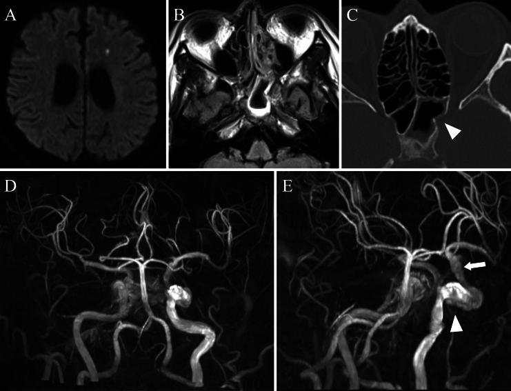 Proximal occlusion for infectious carotid-cavernous fistula caused by invasive fungal sinusitis: illustrative case.