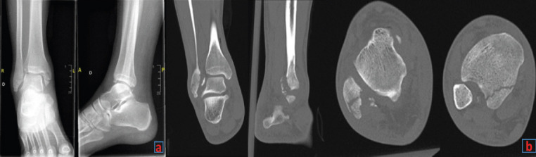 Chronic Syndesmotic Instability Associated with a Complex Lesion of the Posterior Inferior Tibiofibular Ligament: Review, Case Report, and Surgical Report.