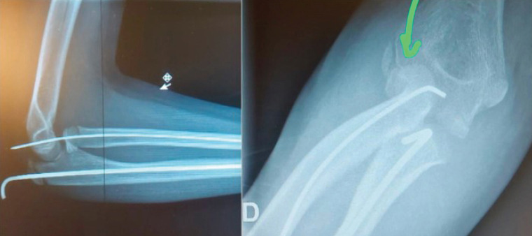 Elbow Dislocation Associated with Severely Displaced Radial Neck Fracture and Ulnar Diaphyseal Fracture in an 11-Year-Old Girl - A Very Rare Case Report.