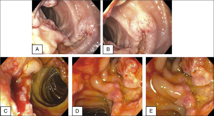 An Unexpected Culprit: Fatal Gastrointestinal Hemorrhage due to Duodenal Histoplasmosis in a Patient With End-Stage Renal Disease.