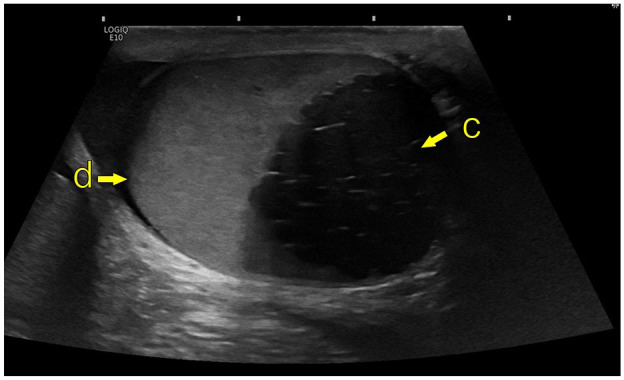 Zinner syndrome: Clinical insights from Western Norway.