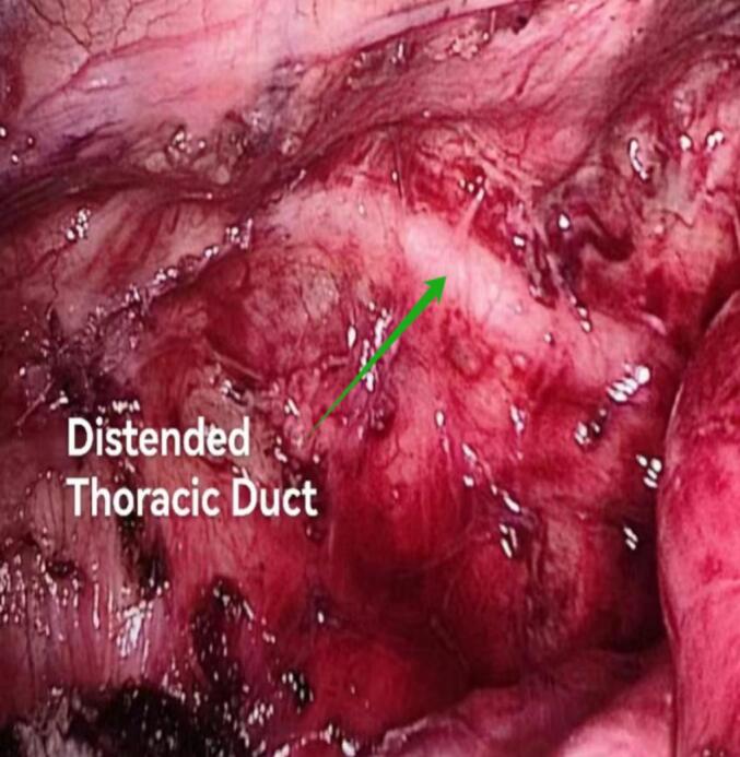 A rare case report of chylopericardium after esophageal cancer surgery: Diagnostic challenges and successful surgical management.