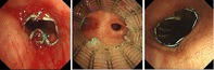 Simultaneous Placement of Multiple Airway Stents in Three Patients With Extensive Airway Stenosis: A Case Series.
