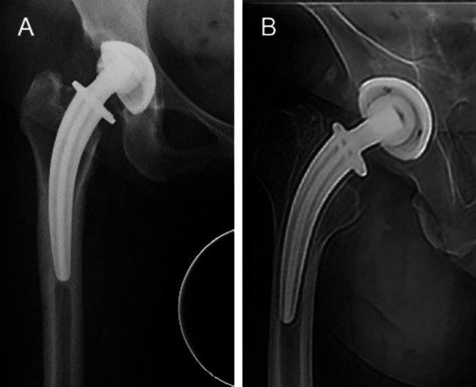 Is Collum Femoris Preserving Stem (CFP) an Epiphyseal-Stabilized Prosthesis? A Long-Term Single-Center Series Follow Up of 705 Cases.