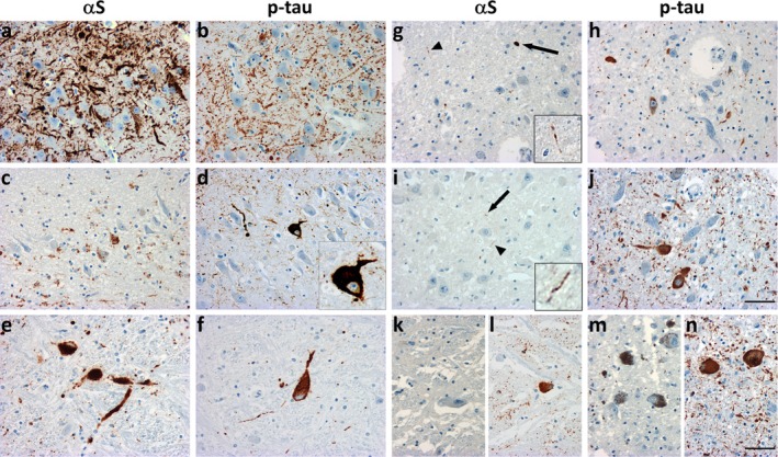 Protein Coaggregation in Caribbean Atypical Parkinsonism: The Contribution of Annonacin.