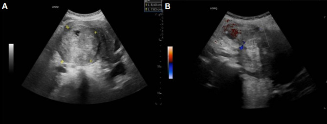 Spontaneous Rupture of a Low-Grade Endometrial Stromal Sarcoma: A Case Report and Review of Imaging.