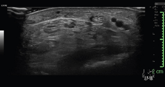 Acute Carpal Tunnel Syndrome: Is It Only Wrist Fractures? A Case Series Report and Literature Review.