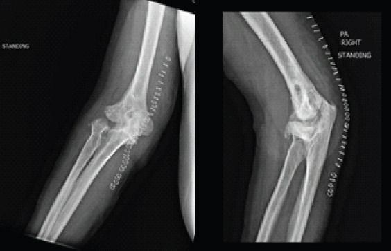 Elbow Interpositional Arthroplasty using an Achilles Tendon Allograft: A Case Report.