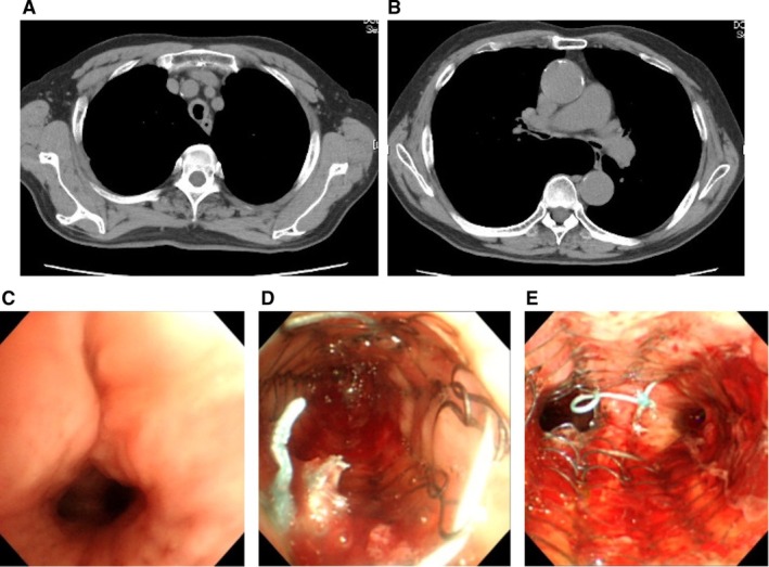 Simultaneous Placement of Multiple Airway Stents in Three Patients With Extensive Airway Stenosis: A Case Series.