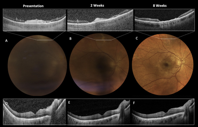 Unilateral uveitis following adjuvanted Varicella-Zoster subunit vaccine in a patient with previously resolved Varicella Zoster acute retinal necrosis.