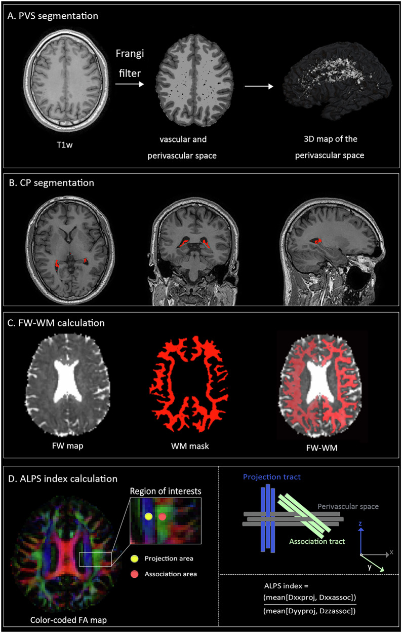 Glymphatic dysfunction associated with cortisol dysregulation in major depressive disorder.