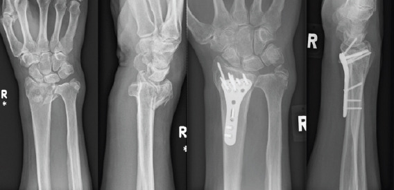 Acute Carpal Tunnel Syndrome: Is It Only Wrist Fractures? A Case Series Report and Literature Review.