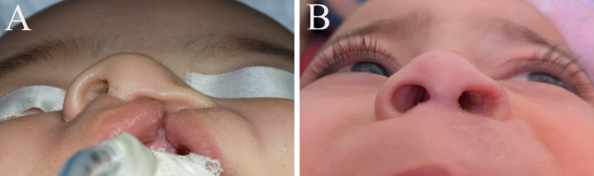 Assessment of symmetry and parental satisfaction after use of customized nasal conformers in unilateral cleft lip repair: a randomized controlled clinical trial.