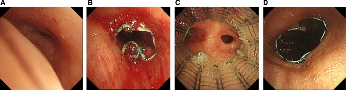 Simultaneous Placement of Multiple Airway Stents in Three Patients With Extensive Airway Stenosis: A Case Series.