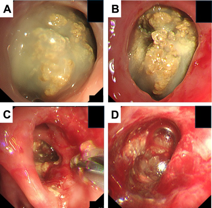 A Case of Bronchoscopic Removal of Aspergilloma in Patients With Non-Surgical Indications.
