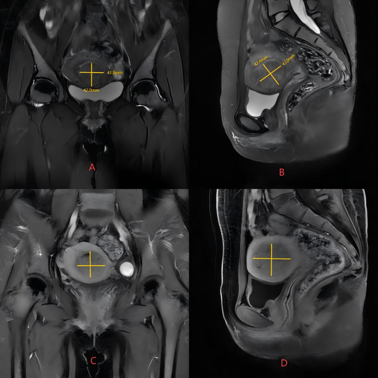 Hysteroscopic Myomectomy for Type 2 Submucosal Myoma Pretreated by HIFU and Mifepristone Treatment: A Case Report and Literature Review.