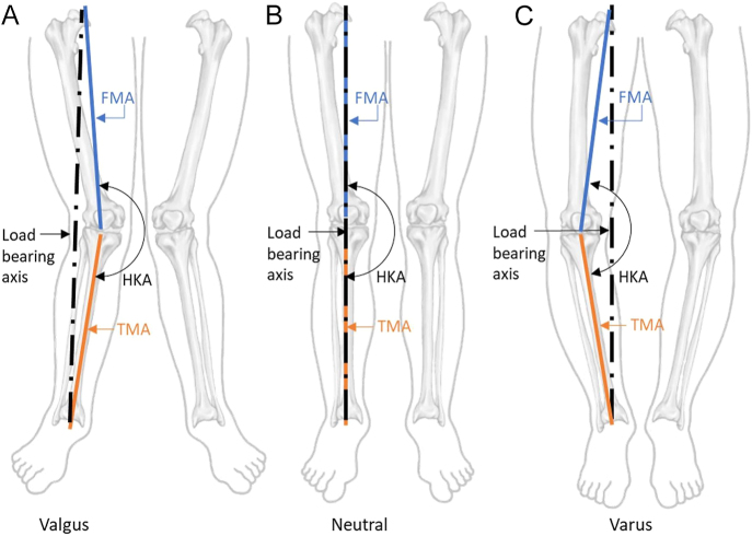 Coronal native limb alignment: establishing reporting standards and aligning measurements of key angles.