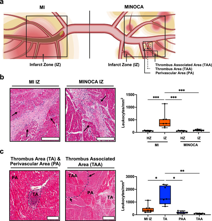 Molecular screening in a translational large animal trial identifies a differential inflammatory response for MINOCA.