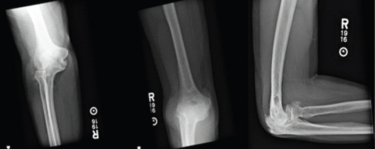 Elbow Interpositional Arthroplasty using an Achilles Tendon Allograft: A Case Report.