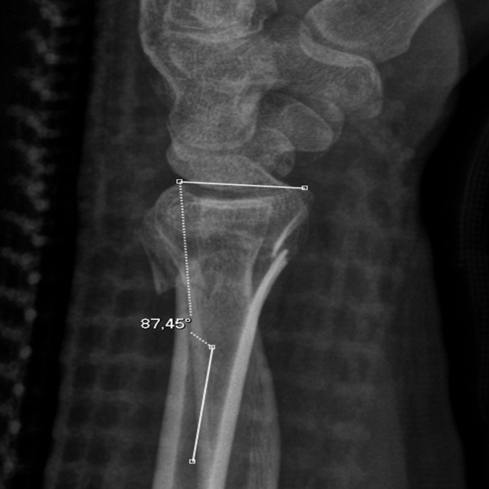 Distal radius fracture - Supination underestimates dorsal tilt in distal radius fracture radiographs: a case report.