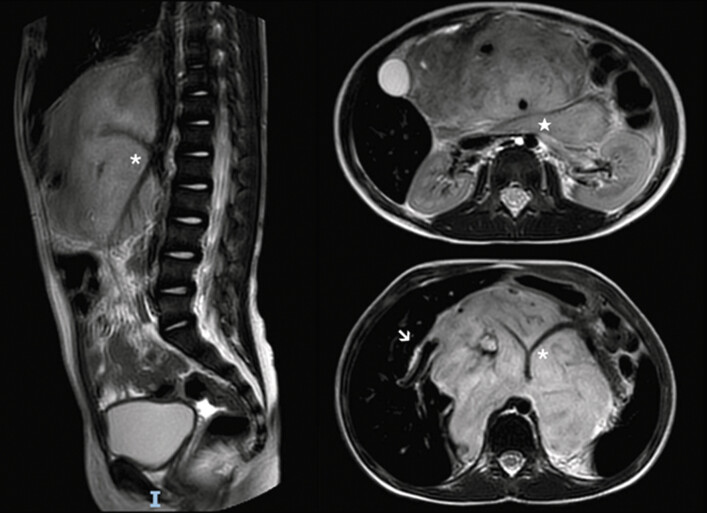Endoscopic Cholecystoduodenostomy With Lumen-Apposing Metal Stent for Bile Duct Stricture in a Child with Neuroblastoma: A Case Report.